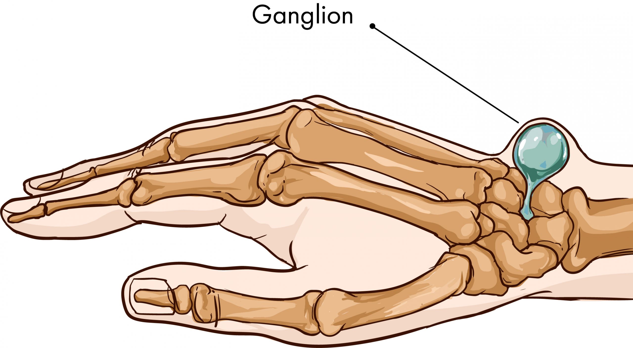 Ganglion Cysts Surgery And Treatment In Montreal