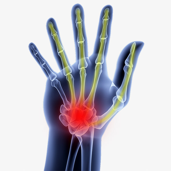 Dr. Sauvageau explains hand surgery for carpal tunnel syndrome and
