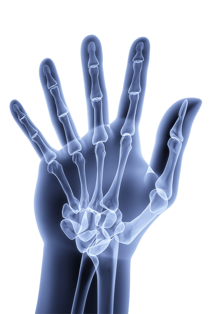 Arthrite articulaire basale du pouce | Hand Surgeon Montreal