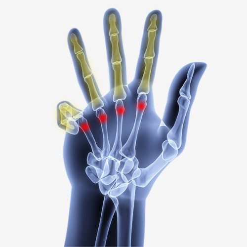 Ulnar Nerve Entrapment at the Wrist - Hand Surgery – Hand Specialist, Montreal & Ottawa