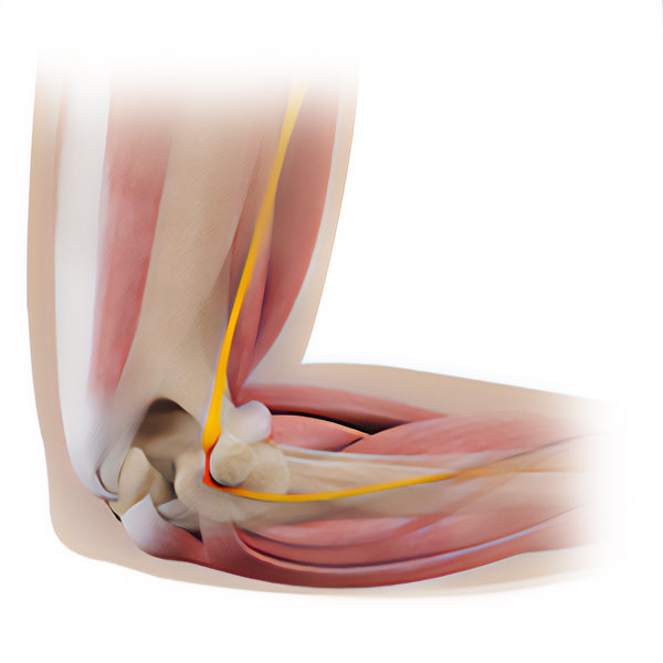 Cubital Tunnel Syndrome Treatment in Montreal