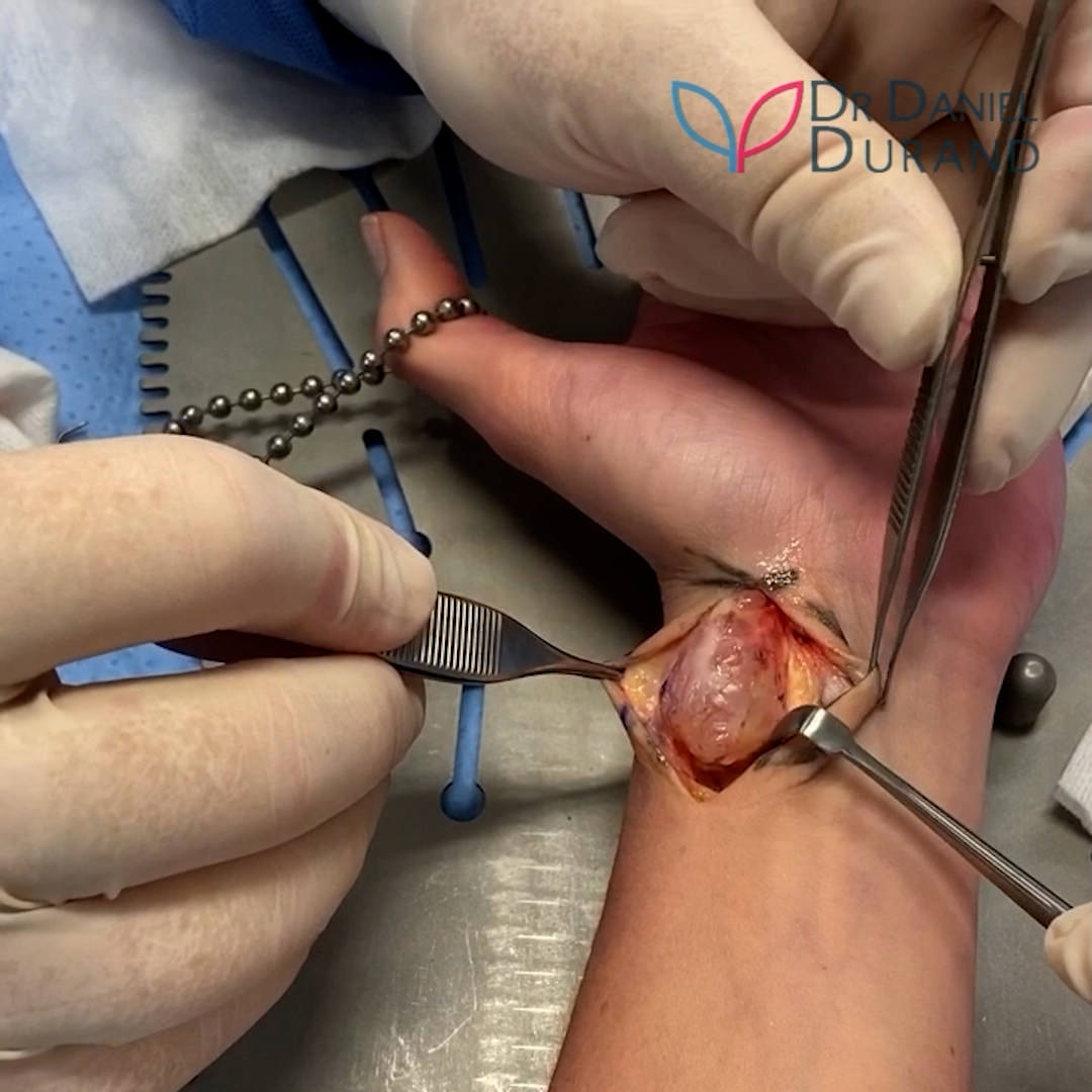 Trigger finger endoscopic treatment in Montreal by Hand Surgeon