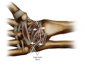 Muscle, Ligament, Tendon Injuries Surgery and treatment in Montreal